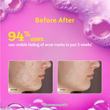 2% Salicylic Acid Face Wash for Acne & Oil Control - 100 ml