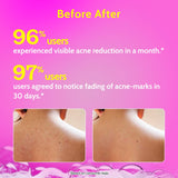 1% Salicylic Acid Body Wash for Acne Control - 473 ml