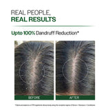 Anti Dandruff Shampoo with Salicylic Acid, Piroctone Olamine & Biotin - 250ml