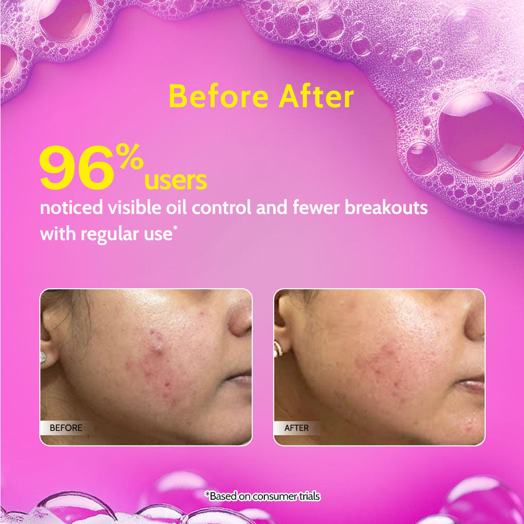 2% Salicylic Acid Face Wash for Acne & Oil Control - 100 ml