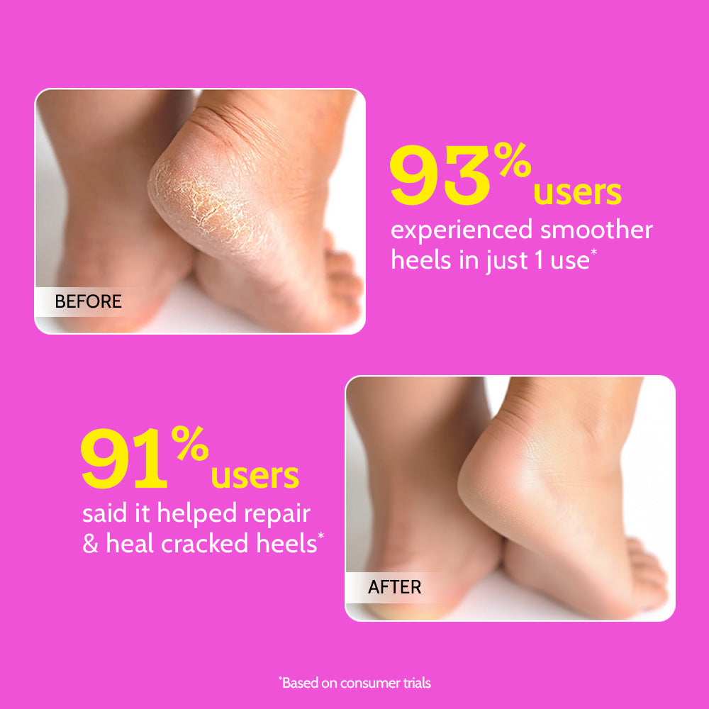 Foot Roll-on for Cracked Heels & Diabetic Foot - 50 gm