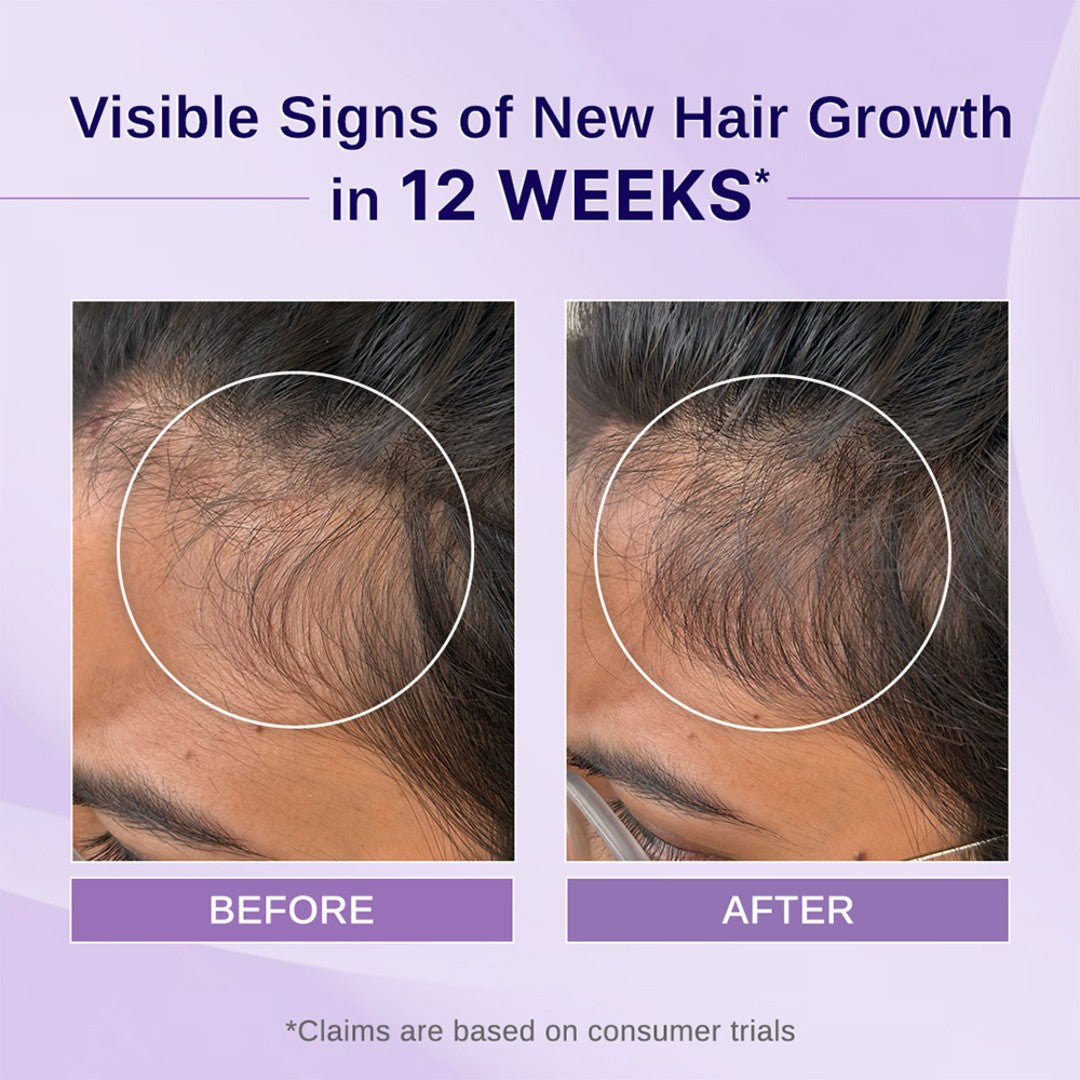 Rosemary & Hibiscus Hair Growth Oil with Redensyl & Biotin - 100